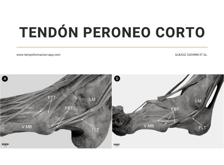 clasificacion-insercion-distal-peroneo-corto